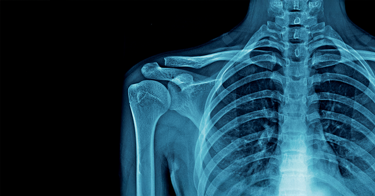 prześwietlona klatka piersiowa człowieka rtg